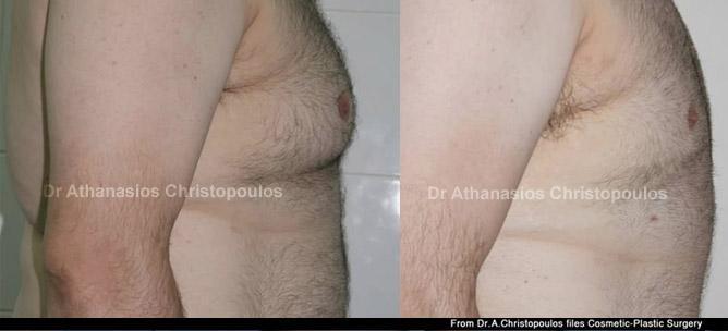 Αντιμετώπιση γυναικομαστίας με λιποαναρρόφηση