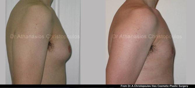 Αντιμετώπιση γυναικομαστίας με λιποαναρρόφηση