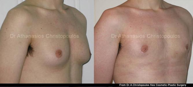 Αντιμετώπιση γυναικομαστίας με λιποαναρρόφηση