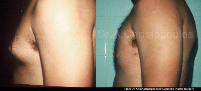 Αντιμετώπιση γυναικομαστίας με λιποαναρρόφηση