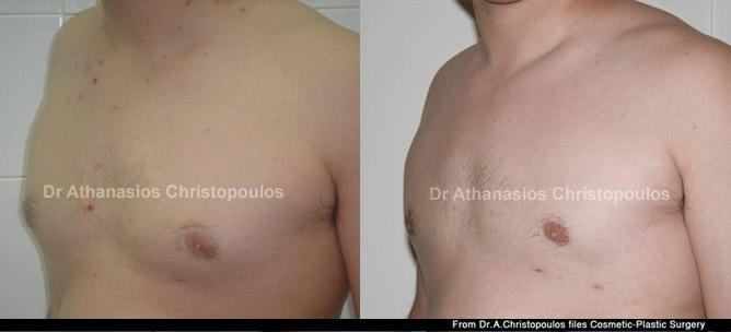 Αντιμετώπιση γυναικομαστίας με λιποαναρρόφηση