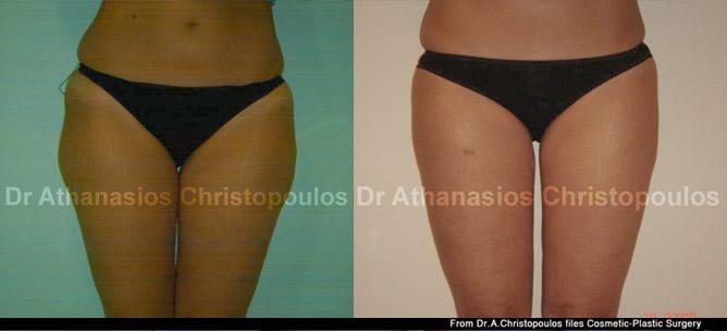 Λιποαναρρόφηση σε έξω & έσω μηρούς