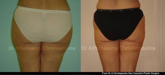 Λιποαναρρόφηση σε έξω & έσω μηρούς