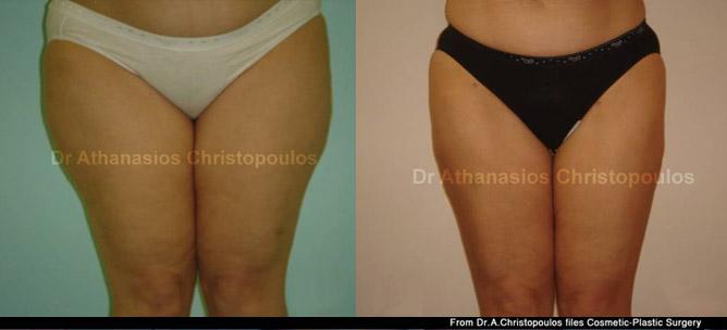 Λιποαναρρόφηση σε έξω & έσω μηρούς