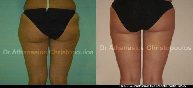 Λιποαναρρόφηση σε έξω & έσω μηρούς