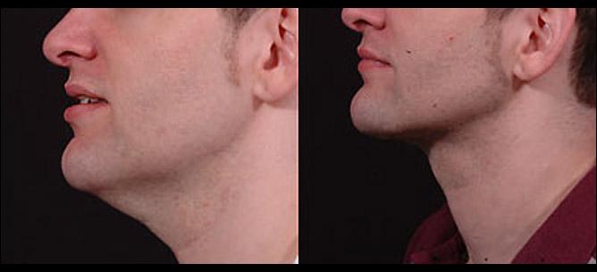 Λιποαναρρόφηση στο πρόσωπο πριν μετα