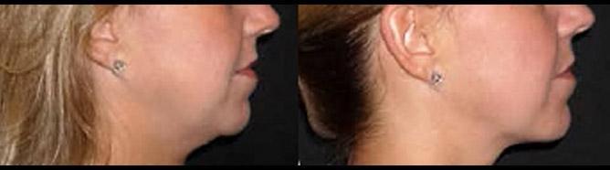 Λιποαναρρόφηση στο πρόσωπο