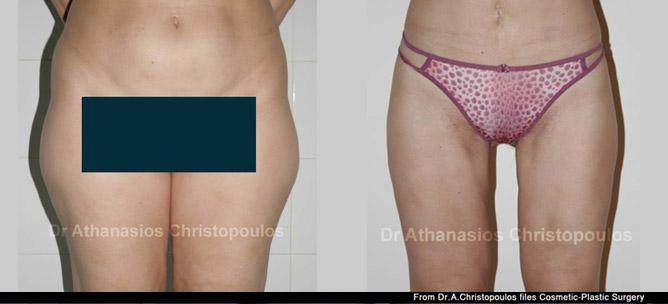 Λιποαναρρόφηση στους μηρούς και στη κοιλιά