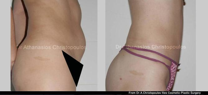 Λιποαναρρόφηση στους μηρούς και στη κοιλιά