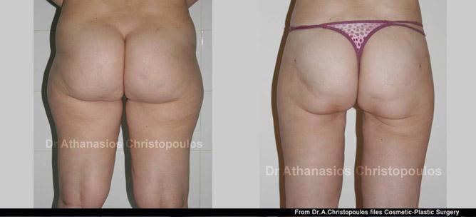 Λιποαναρρόφηση στους μηρούς και στη κοιλιά