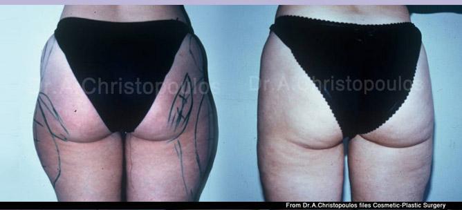 Πριν και μετα Λιποαναρρόφηση στους μηρούς