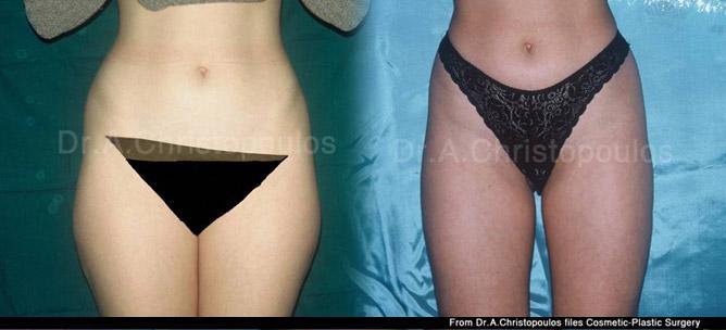 Πριν και μετα Λιποαναρρόφηση στους μηρούς