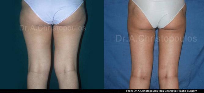 Πριν και μετα Λιποαναρρόφηση στους μηρούς