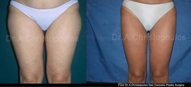 Πριν και μετα Λιποαναρρόφηση στους μηρούς