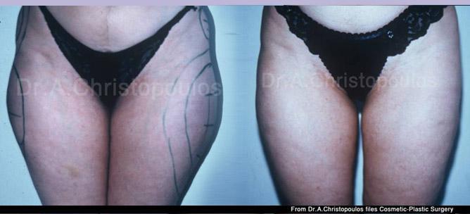 Πριν και μετα Λιποαναρρόφηση στους μηρούς